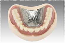 金属床 義歯