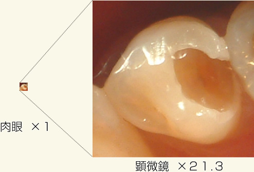 歯の拡大画像